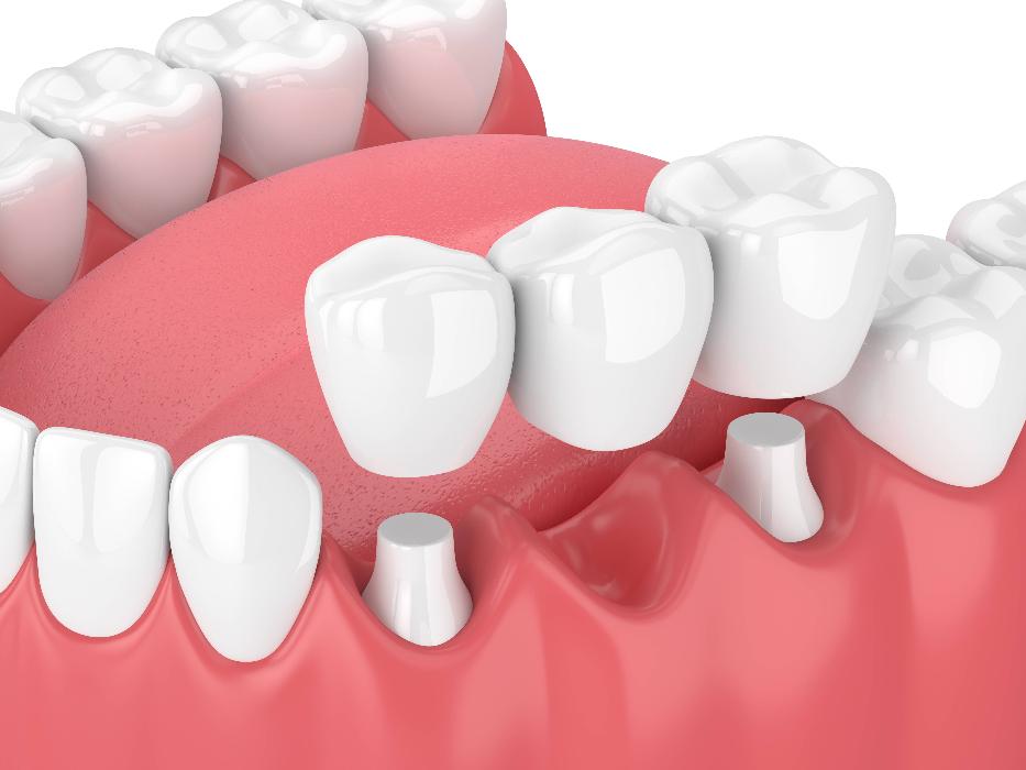 Dental-Care-in-Walnut-Creek-CA1